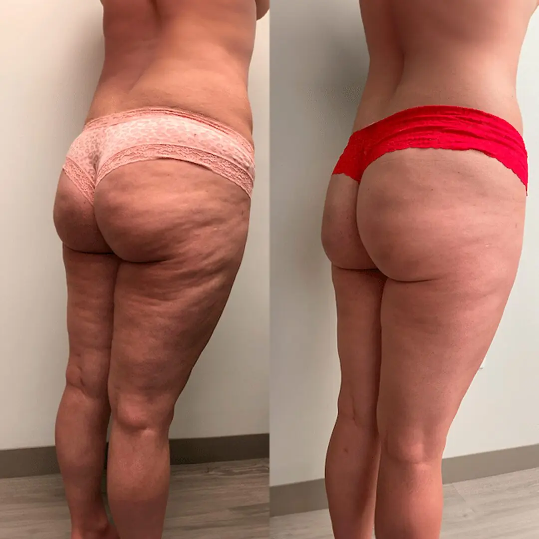 ContouraLift™ 3-in-1 Bodysculpter