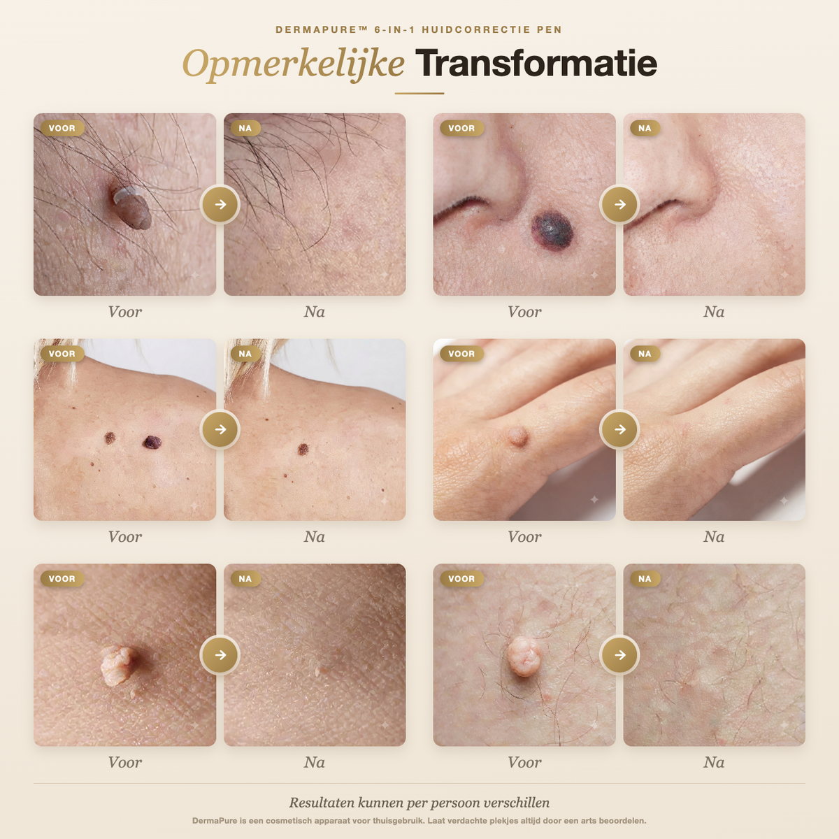 DermaPure™ 6-in-1 Huidcorrectie Pen